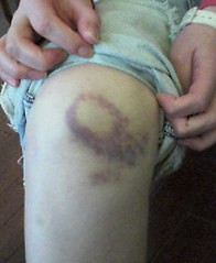 haruko's bruises