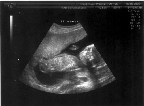 Baby at 17 weeks in utero