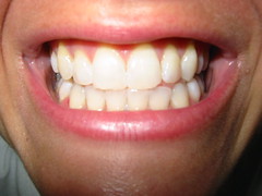 teeth (after)
